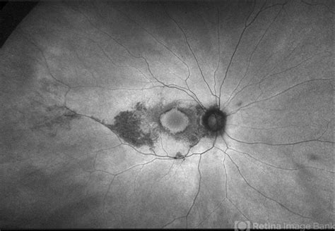 Plaquenil Toxicity - Retina Image Bank