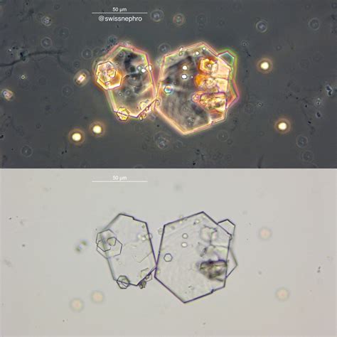 Urine Sediment of the Month: Cystine Crystals - Renal Fellow Network