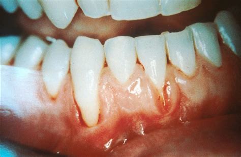 What Are White Gums? Causes And Treatment