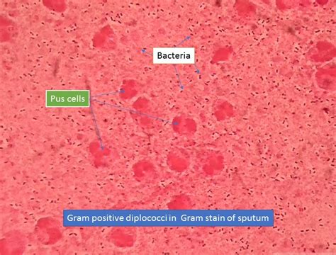 Gram positive diplococci: Introduction, Pathogenecity, Lab Diagnosis