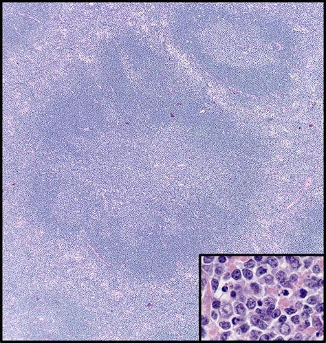 Pediatric-type Follicular Lymphoma