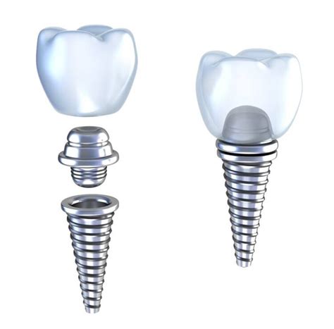 What is Dental Implant Abutment? Types and Cost