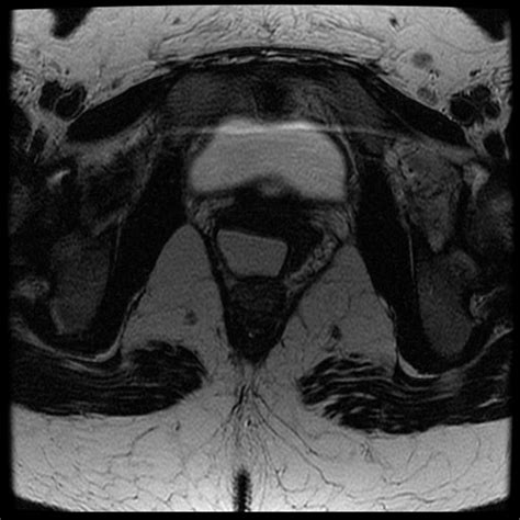 Gartner Cyst Surgery