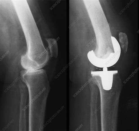 Before and after a total knee replacement, X-ray - Stock Image - C053 ...