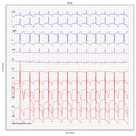 Hypertrophic Cardiomyopathy (HCM) & Hypertrophic Obstructive ...