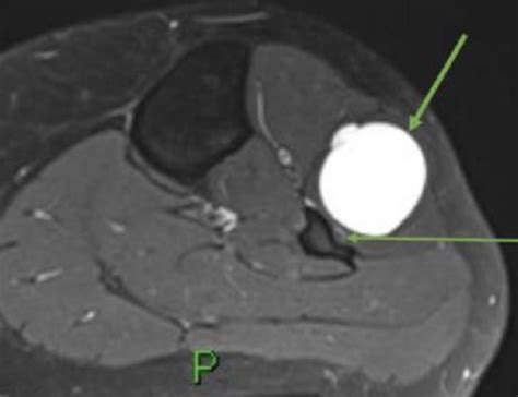 Proximal Tibiofibular Joint Ganglion Cysts - Knee & Sports - Orthobullets