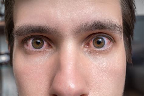 What Can Cause Bloodshot Eyes? | Atlantic Eye Institute