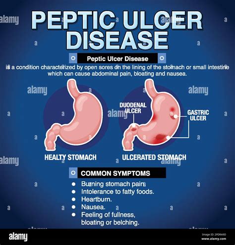 Peptic Ulcer Disease Causes Symptoms Diagnosis Treatment Pathology ...