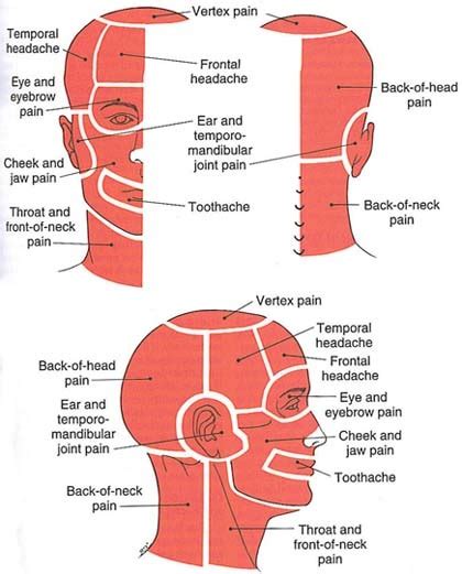 What does where the pain lies tell you about the nature of a headache? - Myofascial Pain Solutions