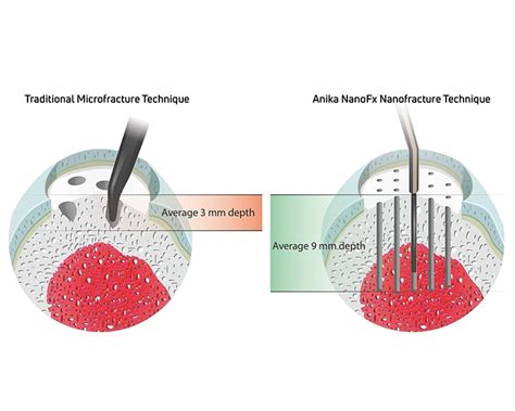 NanoFx - Microfracture Surgery - Anika