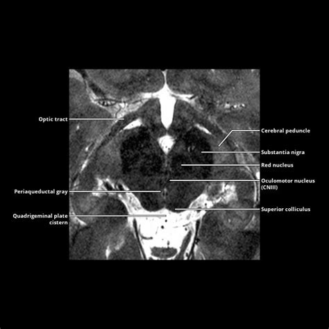 Midbrain | Radiology Key