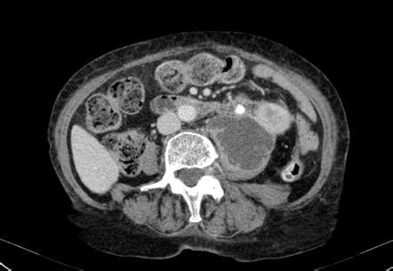 Perinephric abscess | Radiology Reference Article | Radiopaedia.org