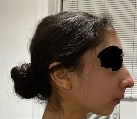 Please help! What would improve my side profile? Rhinoplasty ...