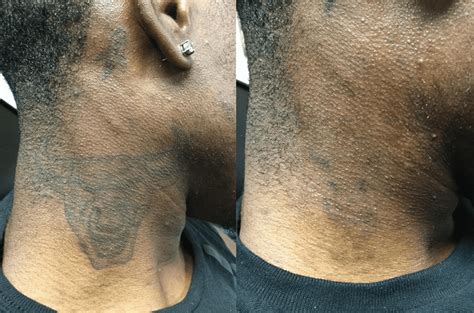 Vol 2: Top 6 Tattoo Removals on Dark Skin Types | Removery