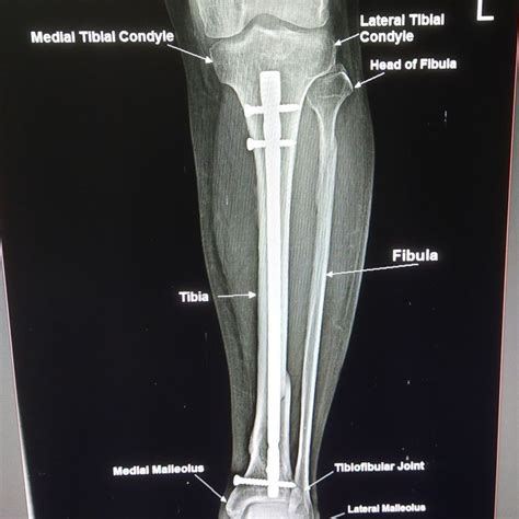 X ray Leg AP view basic Anatomy #Trending#leg #xray #anatomy in 2022 | Anatomy, X ray, Leg anatomy