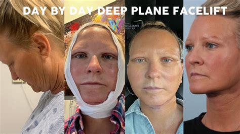 Day by Day Deep Plane Facelift Recovery (6 weeks post-op) - YouTube