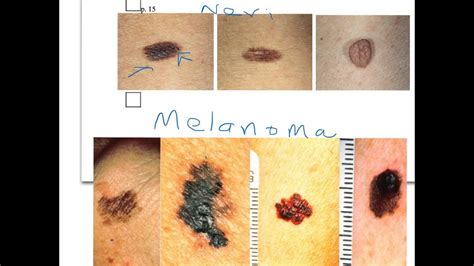 Benign Nevus Vs Melanoma