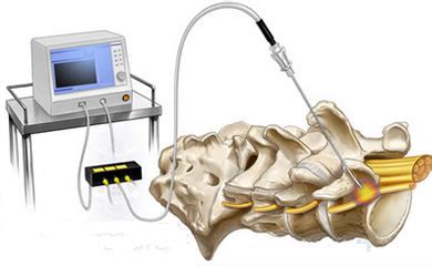 Facet denervation through rhizolysis - Articles of interest - Surginnova