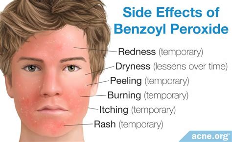 Everything You Need to Know About Benzoyl Peroxide - Acne.org