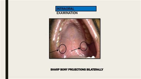 PTERYGOID HAMULUS SYNDROME- A CASE REPORT