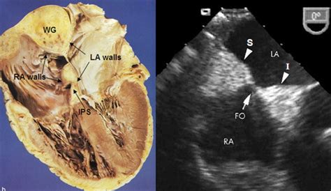 Lipomatous Hypertrophy of the Interatrial Septum Revisited - Journal of the American Society of ...