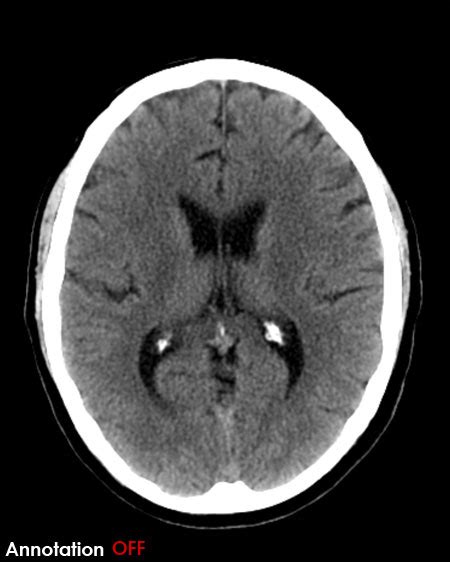 Normal Ct Brain