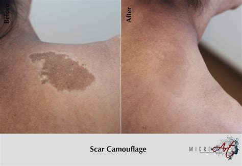 Scar Treatment By MicroArt Semi Permanent Scar Camouflage