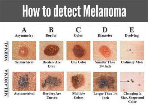 How To Tell The Difference Between A Mole And Cancer - CancerWalls