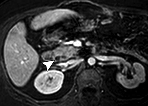 Benign Biliary Strictures: A Current Comprehensive Clinical and Imaging ...