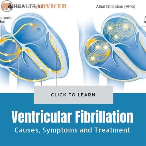 Ventricular Fibrillation: Causes, Picture, Symptoms, And Treatment