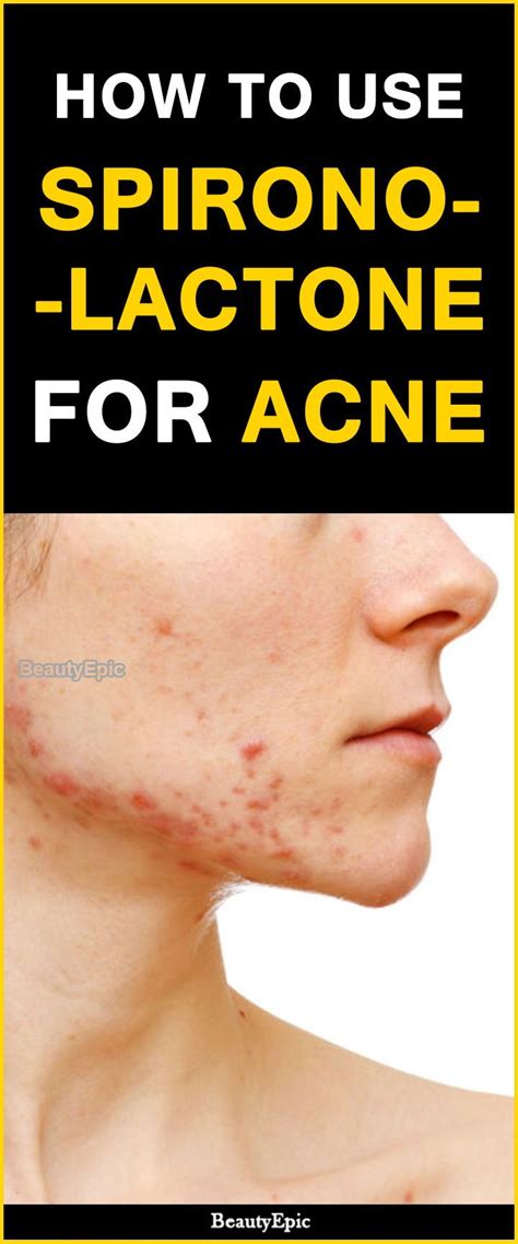 How Effective Is Spironolactone For Acne? | Spironolactone acne, Face acne, Acne