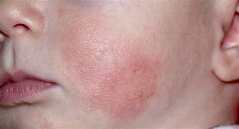 Baby eczema: causes, symptoms, treatments and creams - BabyCenter Australia