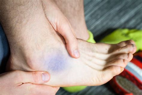 Bruise near ankle stock image. Image of runners, barefoot - 100850513