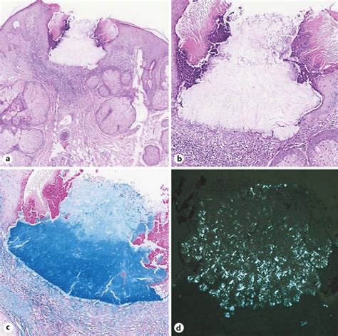 Follicular invagination with cellular debris and keratin lamellae,... | Download Scientific Diagram