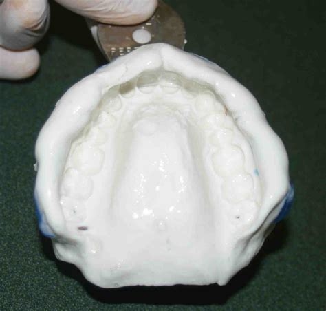 Upper Alginate Web » Lee Ann Brady, DMD's Dental Blog