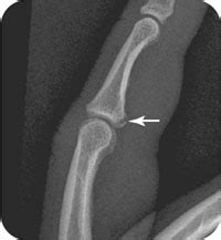 Volar Plate Fracture Radiology