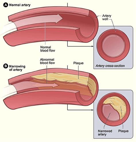 Atherosclerosis - Causes, Risk Factors, Symptoms, Diagnosis & Treatment