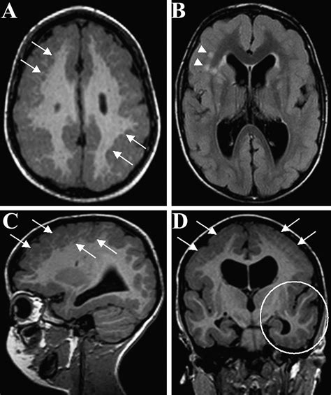 A Novel GPR56 Mutation Causes Bilateral Frontoparietal Polymicrogyria - Pediatric Neurology