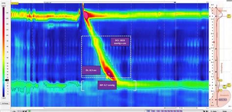 Esophageal manometry study, prep, procedure, results & risks