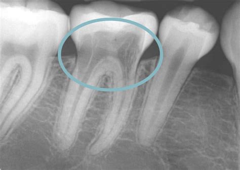 An Explanation of Tooth Resorption - Laurel Dental Clinic