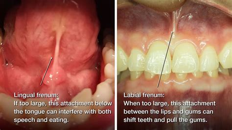 Frenectomy