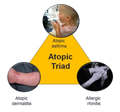 Atopic triad | Asthma, Asthma symptoms, Dermatitis