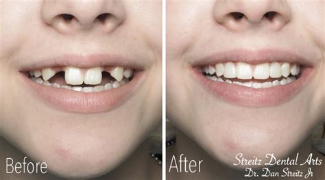 Before and After Photos of Dental Implants and Cosmetic Dentistry