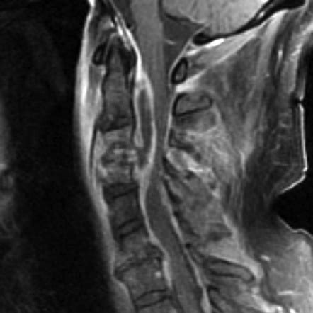 Spinal Epidural Abscess