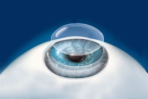 Cornea Clinic – Alphonsa Eye Hospital