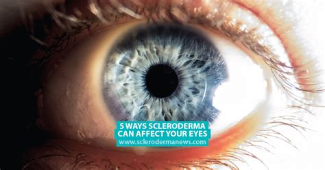 5 Ways Scleroderma Can Affect Your Eyes - Scleroderma News