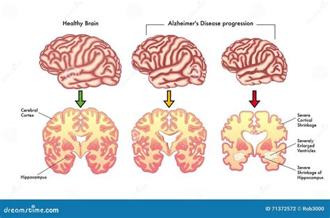 Alzheimer's Disease Progression Vector Illustration | CartoonDealer.com ...