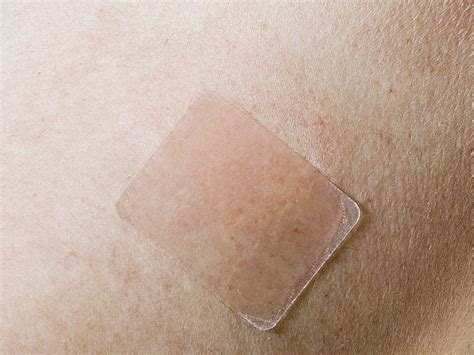 Daytrana ADHD Patch May Cause Permanent Skin Color Changes