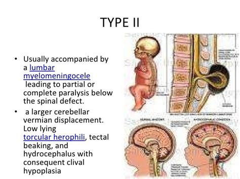 A Case of Syringomyelia with Arnold-Chiari Malformation