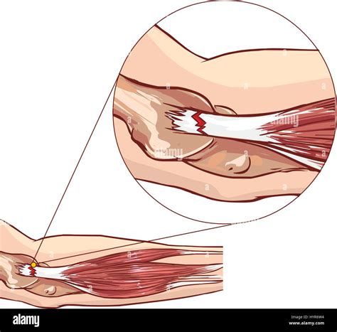 Common extensor tendon Stock Vector Images - Alamy